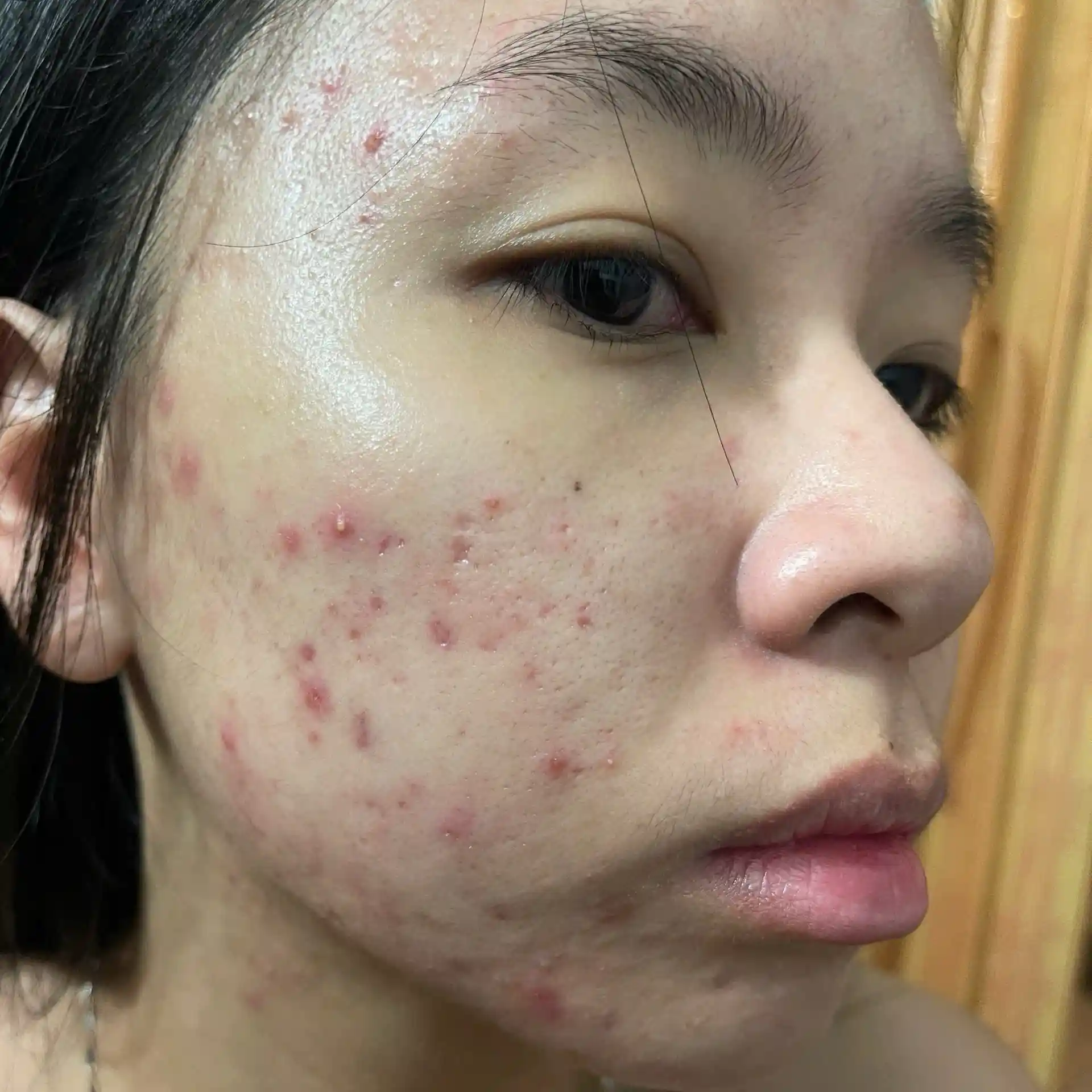 Ngày 1 - Nền da khách hàng bùng mụn mủ viêm nặng